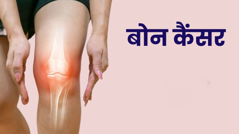 रात का हड्डियों का दर्द कर सकता है बोन कैंसर का इशारा, तुरंत जानें लक्षण –